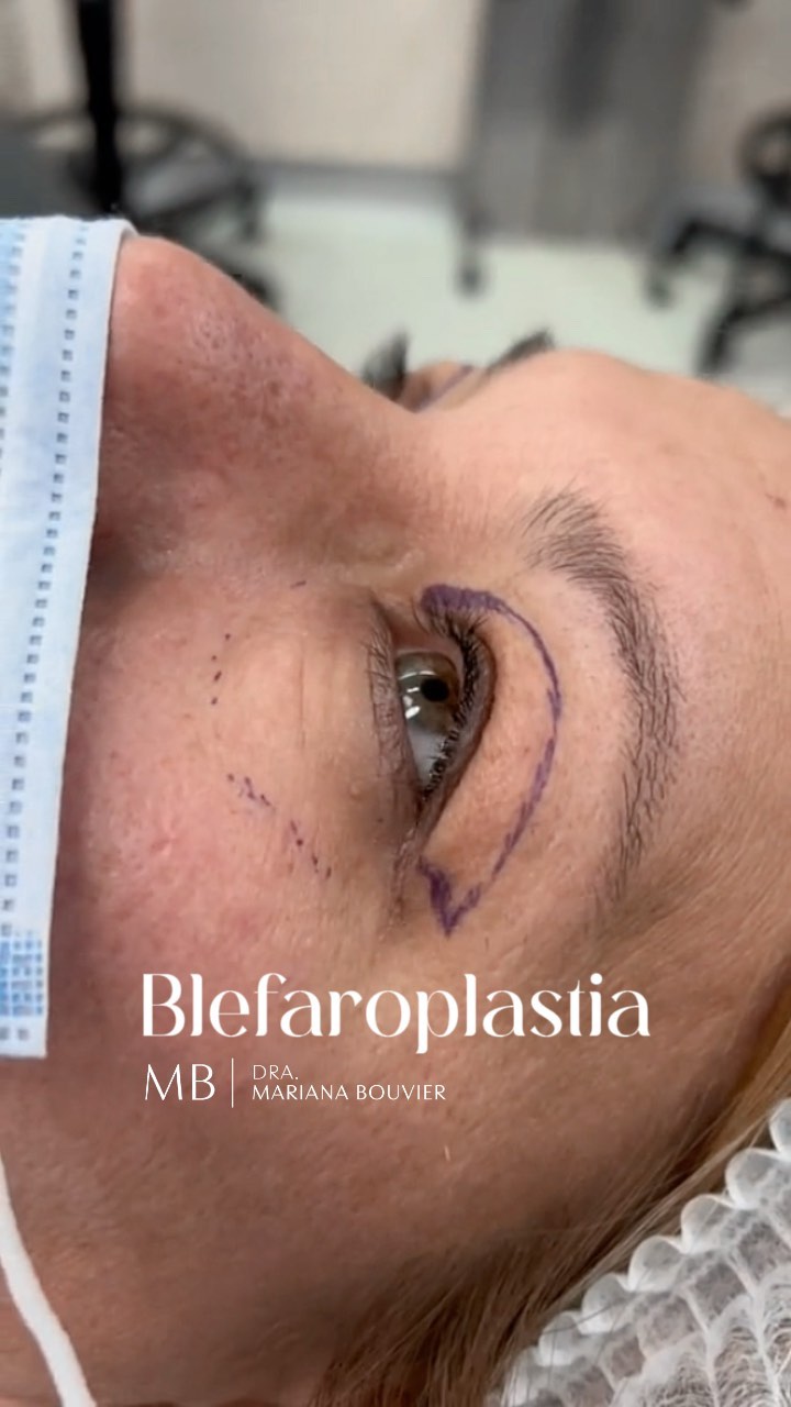 Marcación del párpado antes de una blefaroplastia, en el quirófano