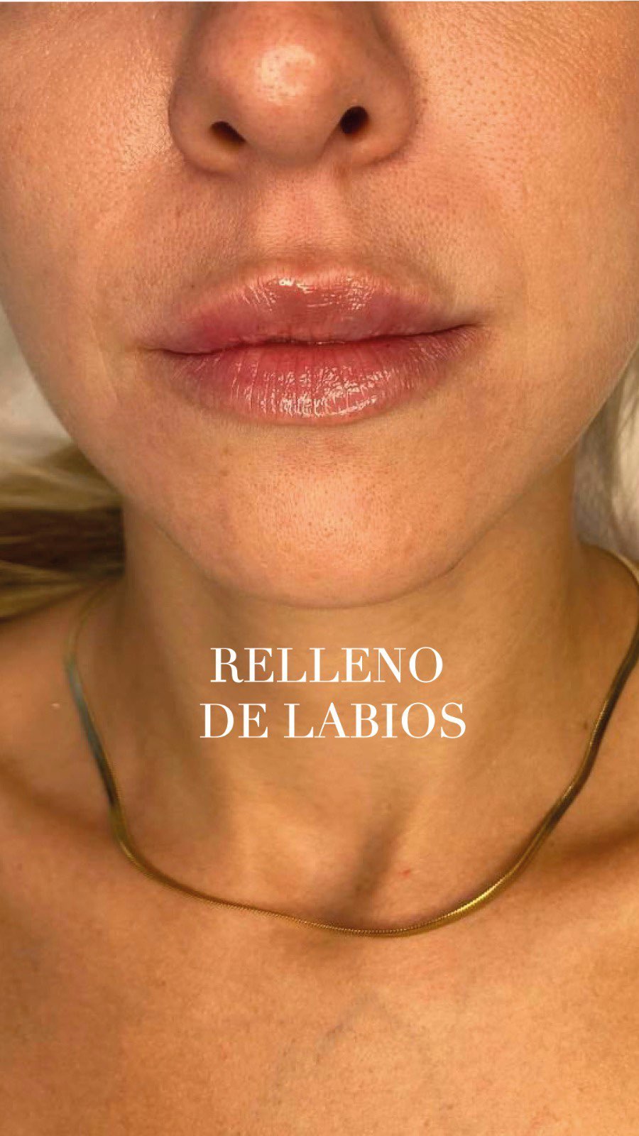 Labios después de un relleno con ácido hialurónico, en primer plano